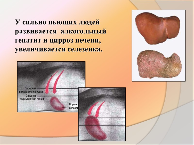 У сильно пьющих людей развивается  алкогольный гепатит и цирроз печени, увеличивается селезенка.
